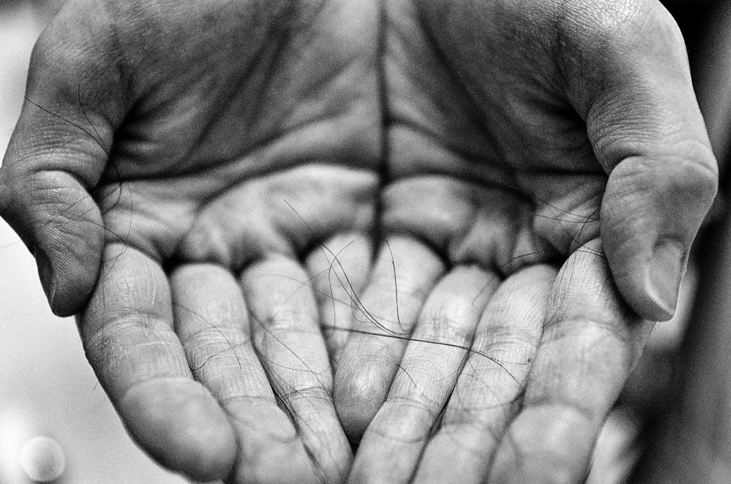 Due to her chemotherapy treatment, hair falls out every time Jen runs her hands over her head. [Angelo Merendino/Al Jazeera] 