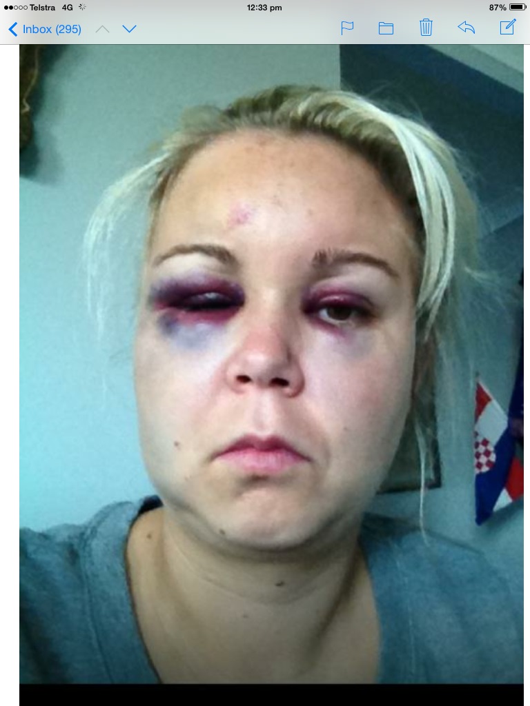 Angela Ivancevic barely survived her husband's brutality [Angela Ivancevic/Al Jazeera]