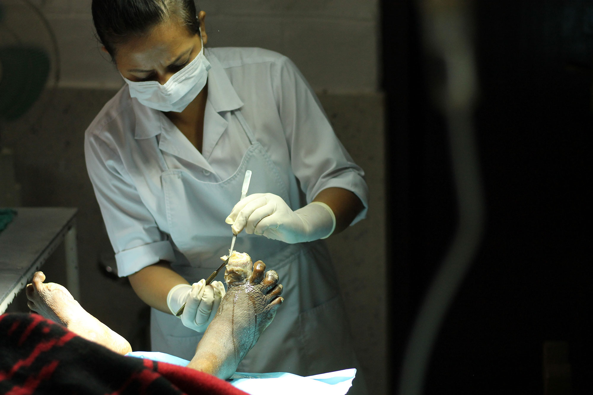 LEPROSY, Nepal/ Please Do Not Use