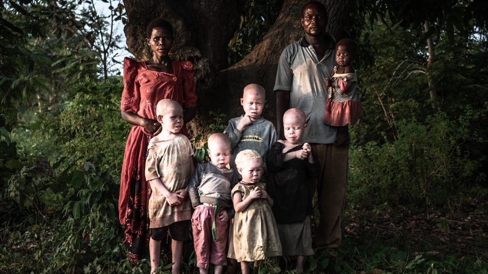 DO NOT USE! Albinism - Fredrik Lerneryd