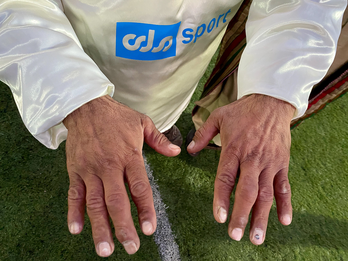 A Buzkashi player shows the scars of his older injuries received during games which can get very violent. “Its only second day and we have already seen nine injuries, including a police officer