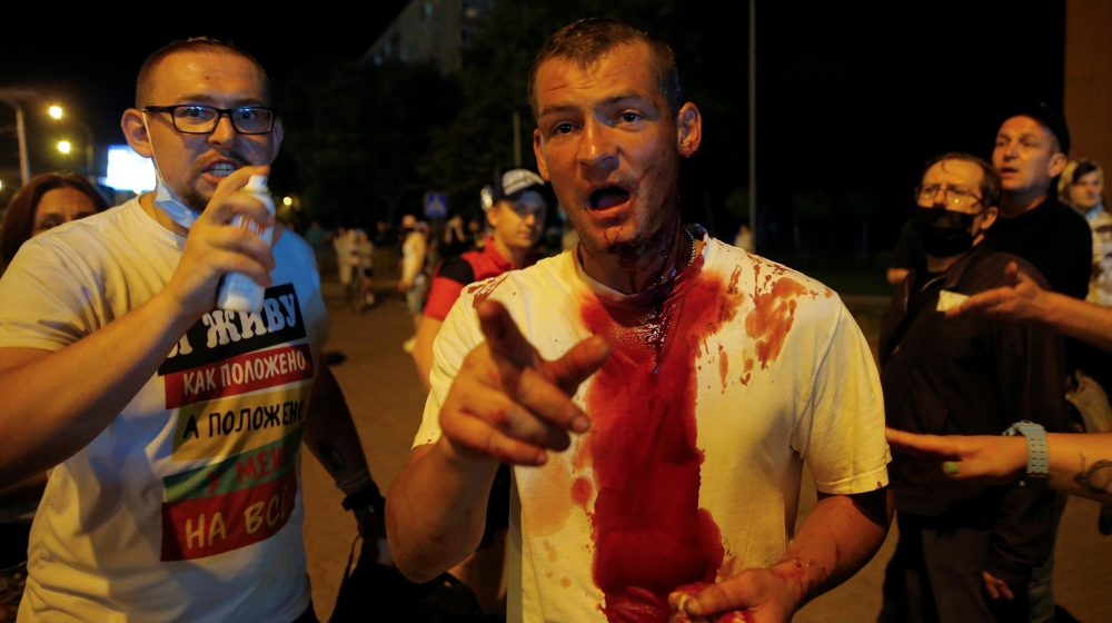 An injured man gestures as he attends a rally following the presidential election in Minsk, Belarus August 10, 2020. The opposition rejected official election results handing President Alexander Lukas