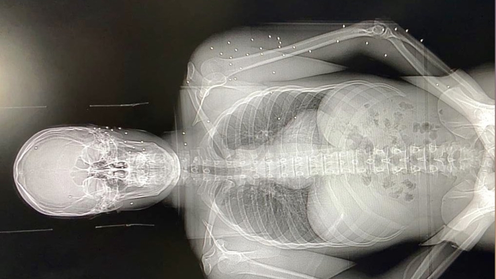 Beirut explosion: At least 50 metal pellets were spread across the body