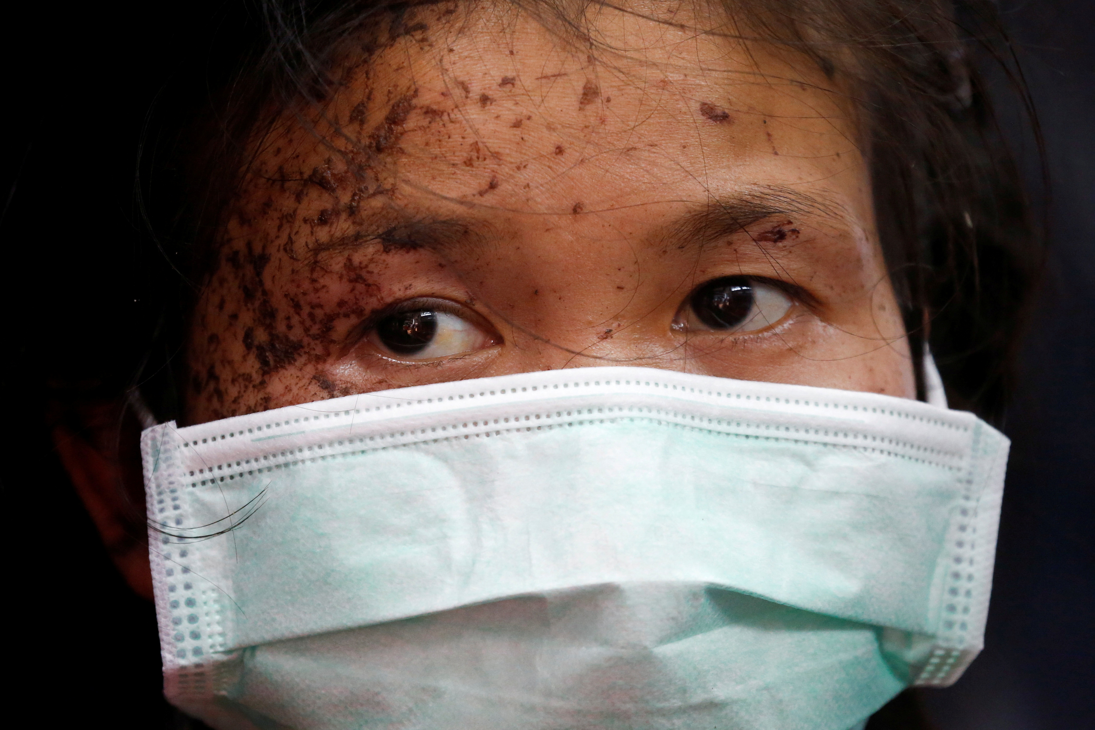 A wounded person who is fleeing the violence in Myanmar seeks medical treatment at the Thai border village of Mae Sam Laep, Mae Hong Son province, Thailand, March 30, 2021 [File: Soe Zeya Tun/Reuters]