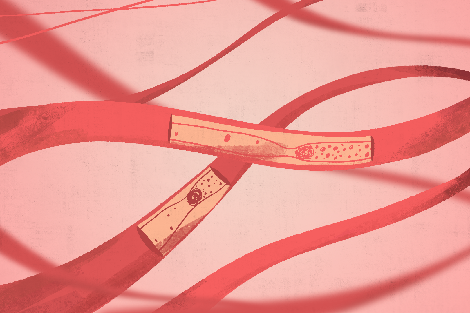 An illustration of a blood clot with a web of blood vessels showing the inside of the front facing blood vessel showing something blocking the flow of blood cells.