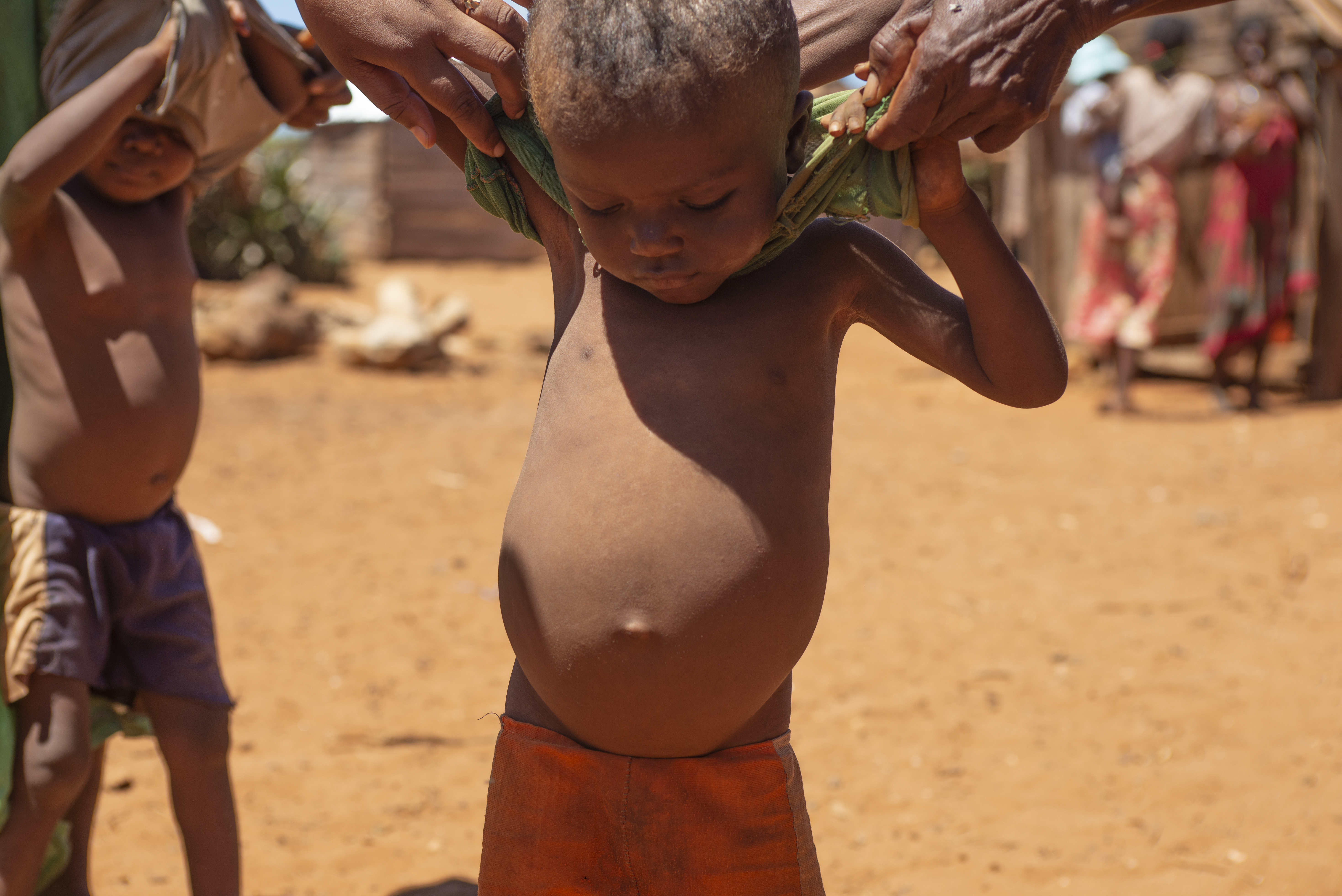 A mother shows her son’s stomach, distended from malnutrition in the village of Erada Beagnatara. [Joseph Stepansky/Al Jazeera]