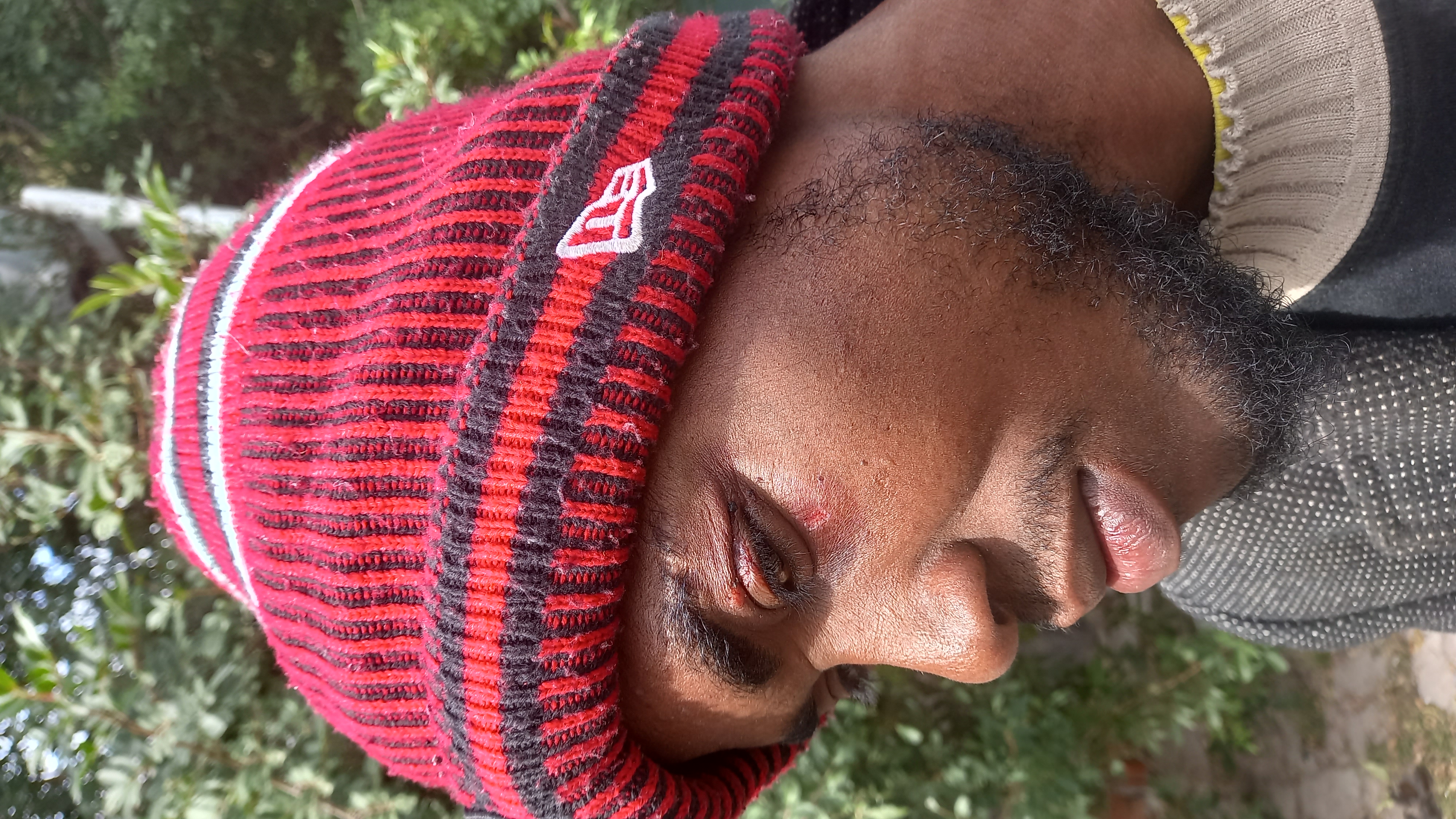 A man in a woolly hat shows his injured face