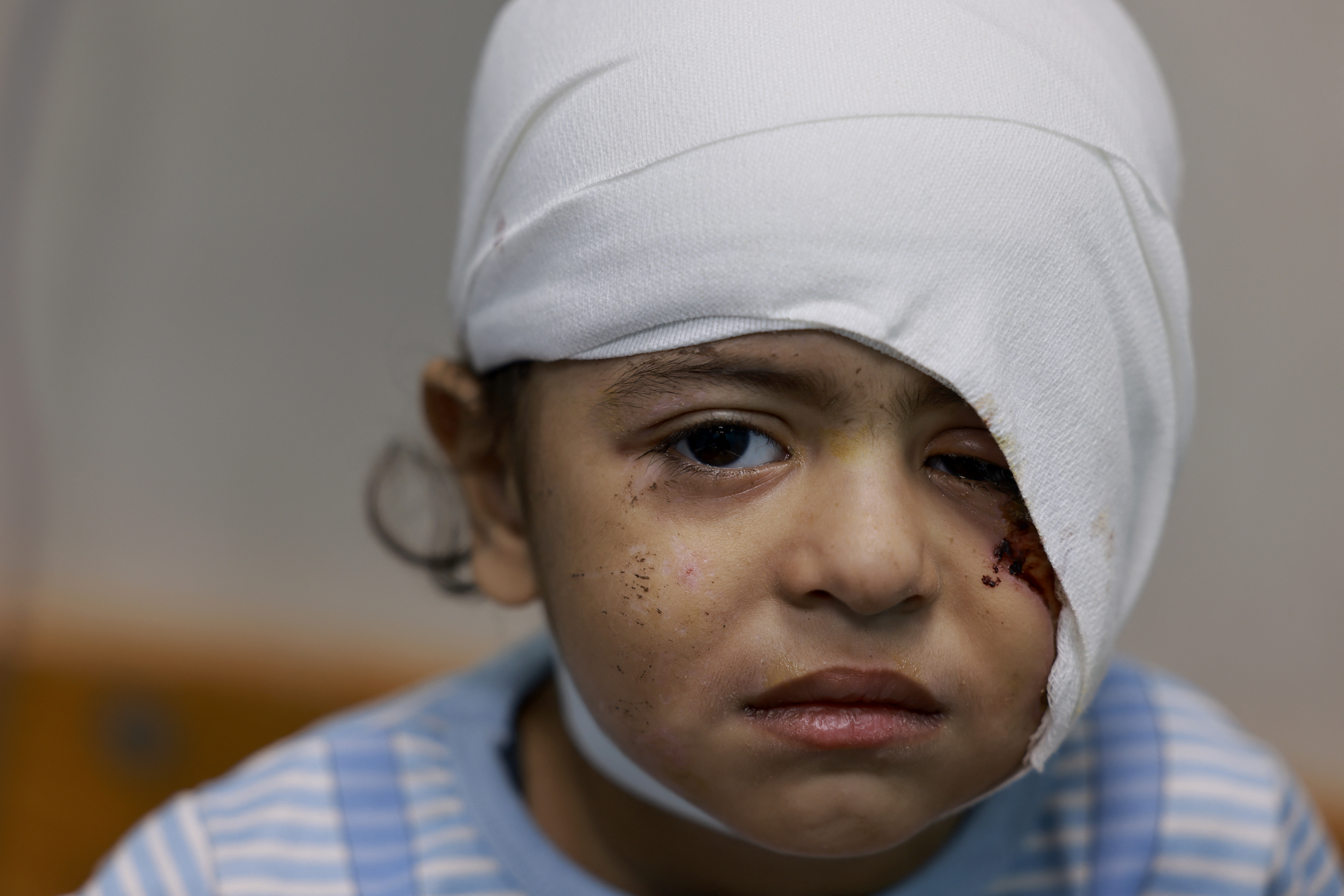 A wounded Palestinian child from the Jabalia refugee camp sits on a bed after being transferred from the Indonesian Hospital in the north to the Naser Hospital in Khan Yunis.