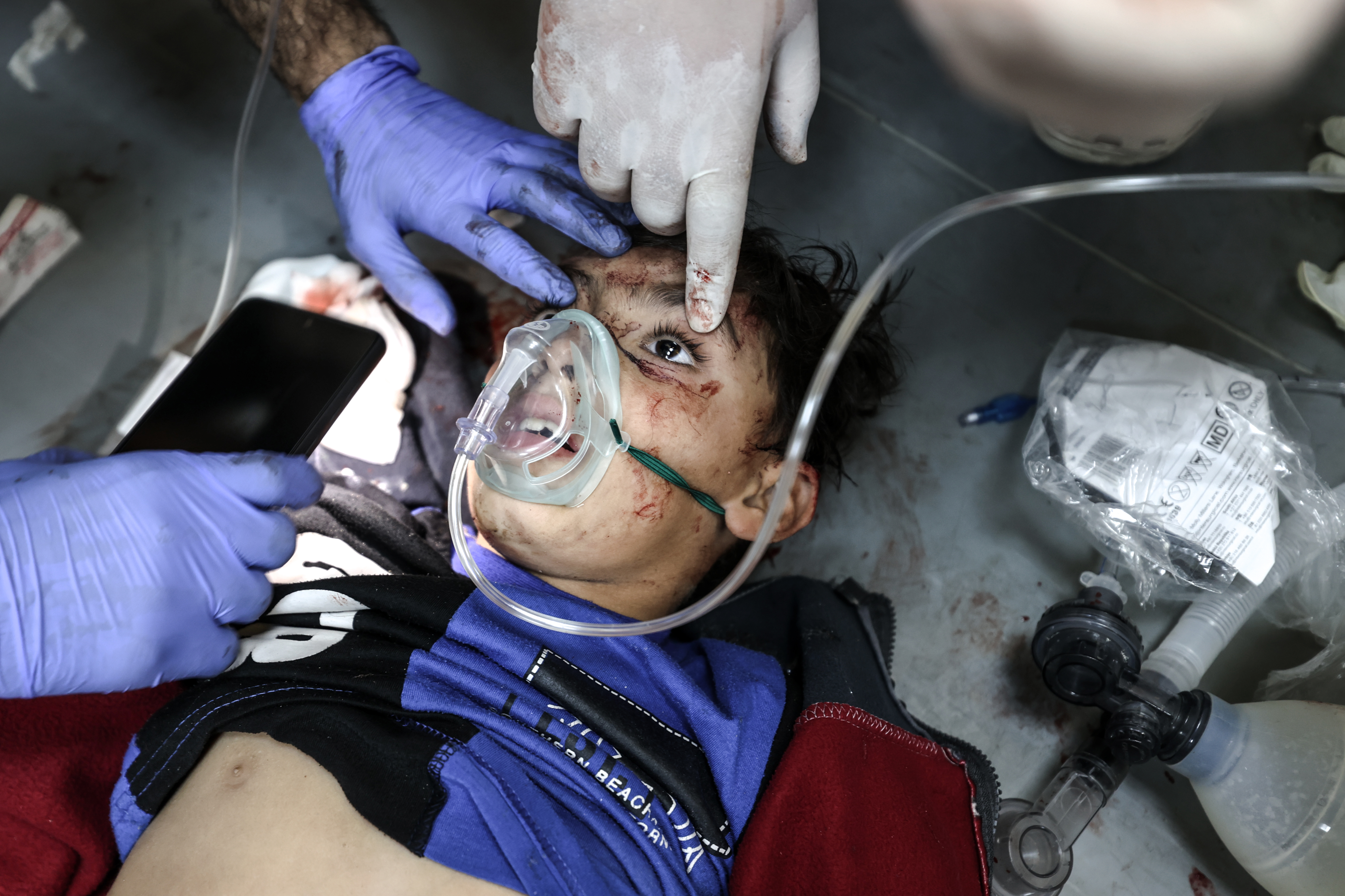 Injured Palestinian children receive treatment at Al-Aqsa Hospital following the bombardment of the Israeli army on Deir al-Balah, Gaza.
