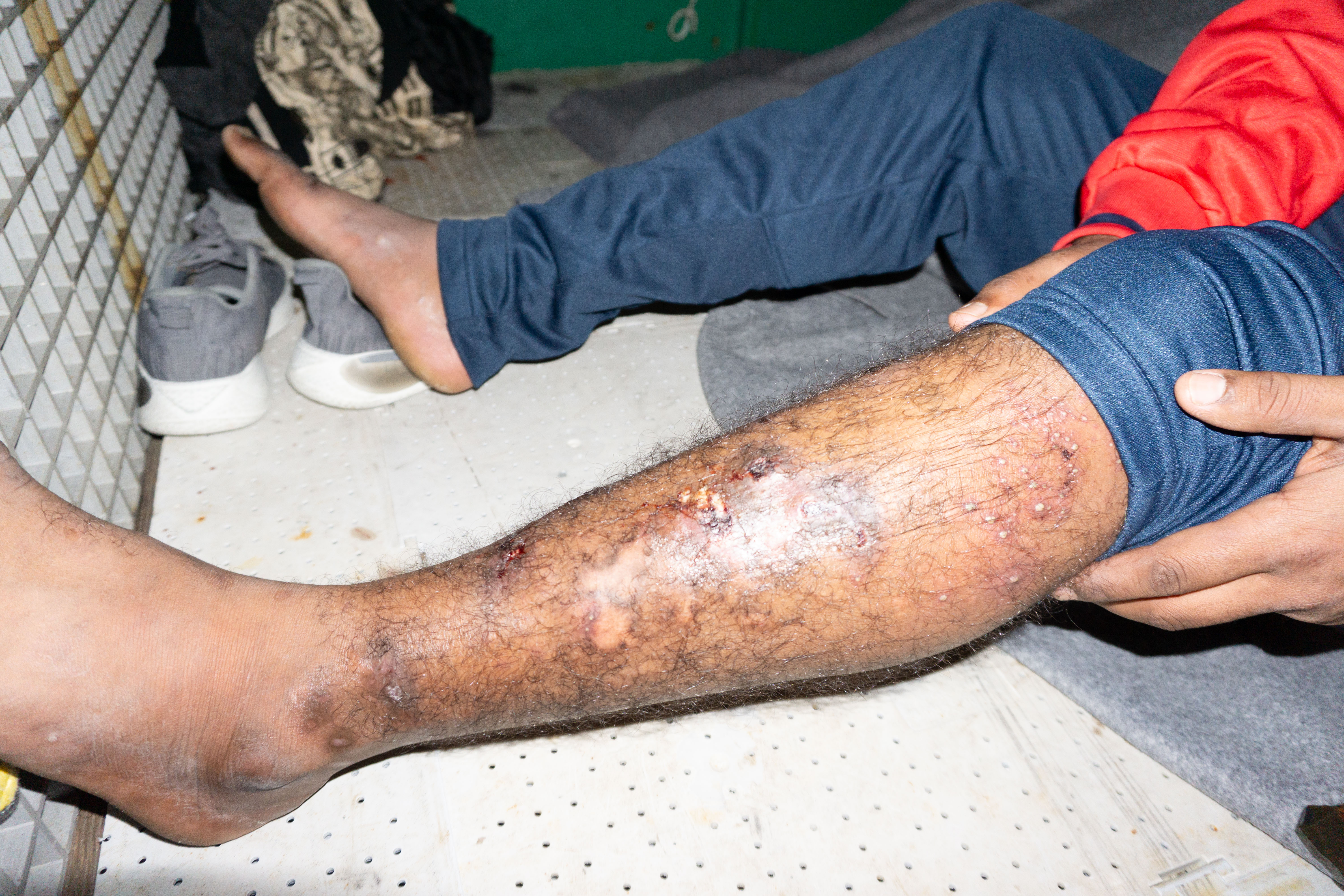 The wounds on Muhammed's legs