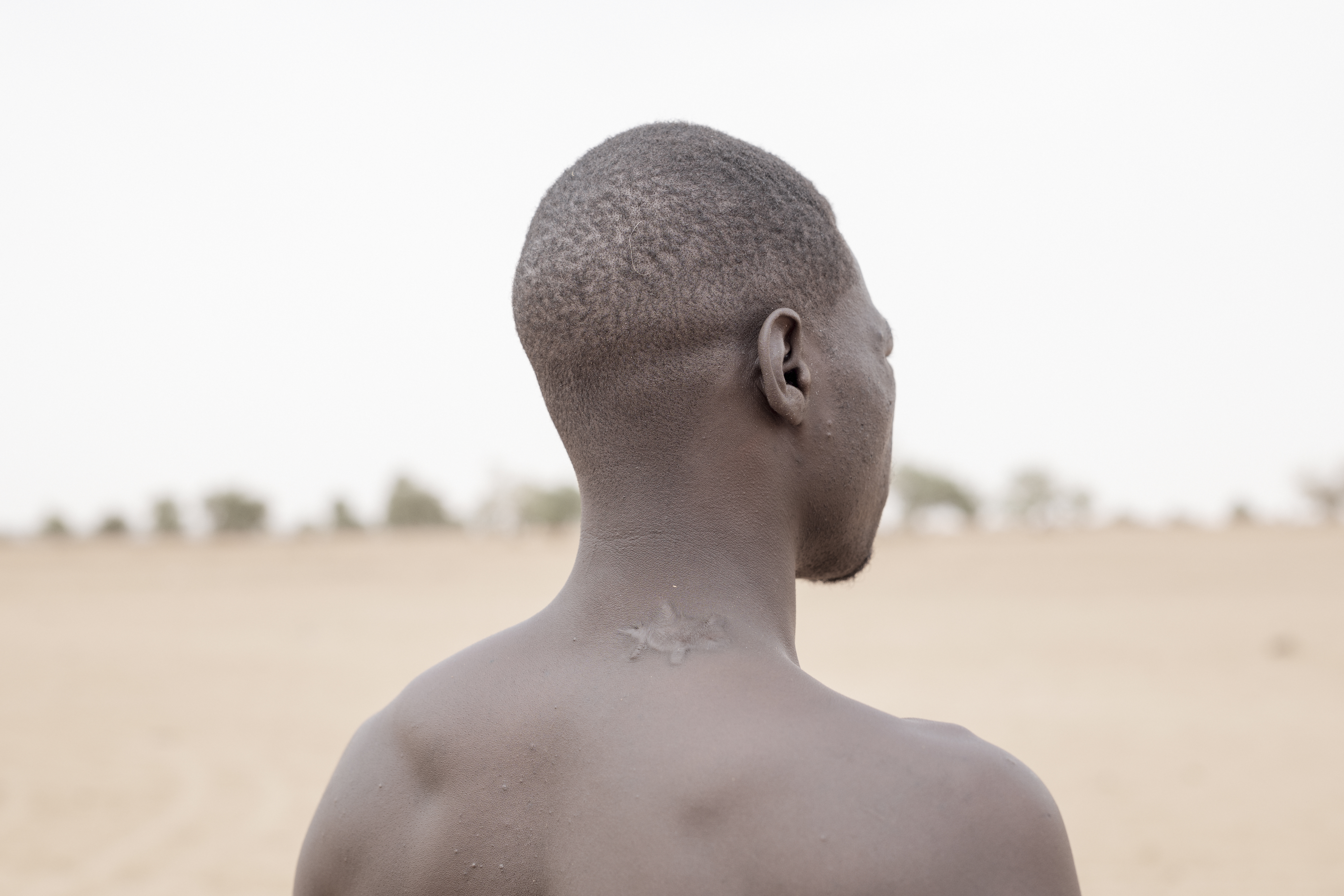 Sudanese refugee, Yahiya Adam, shows the scar of a bullet wound sustained by the RSF. 