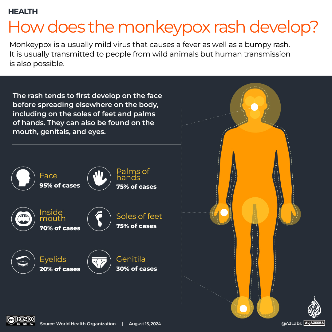 INTERACTIVE_MONKEYPOX August 15_2024_Monkeypox symptoms
