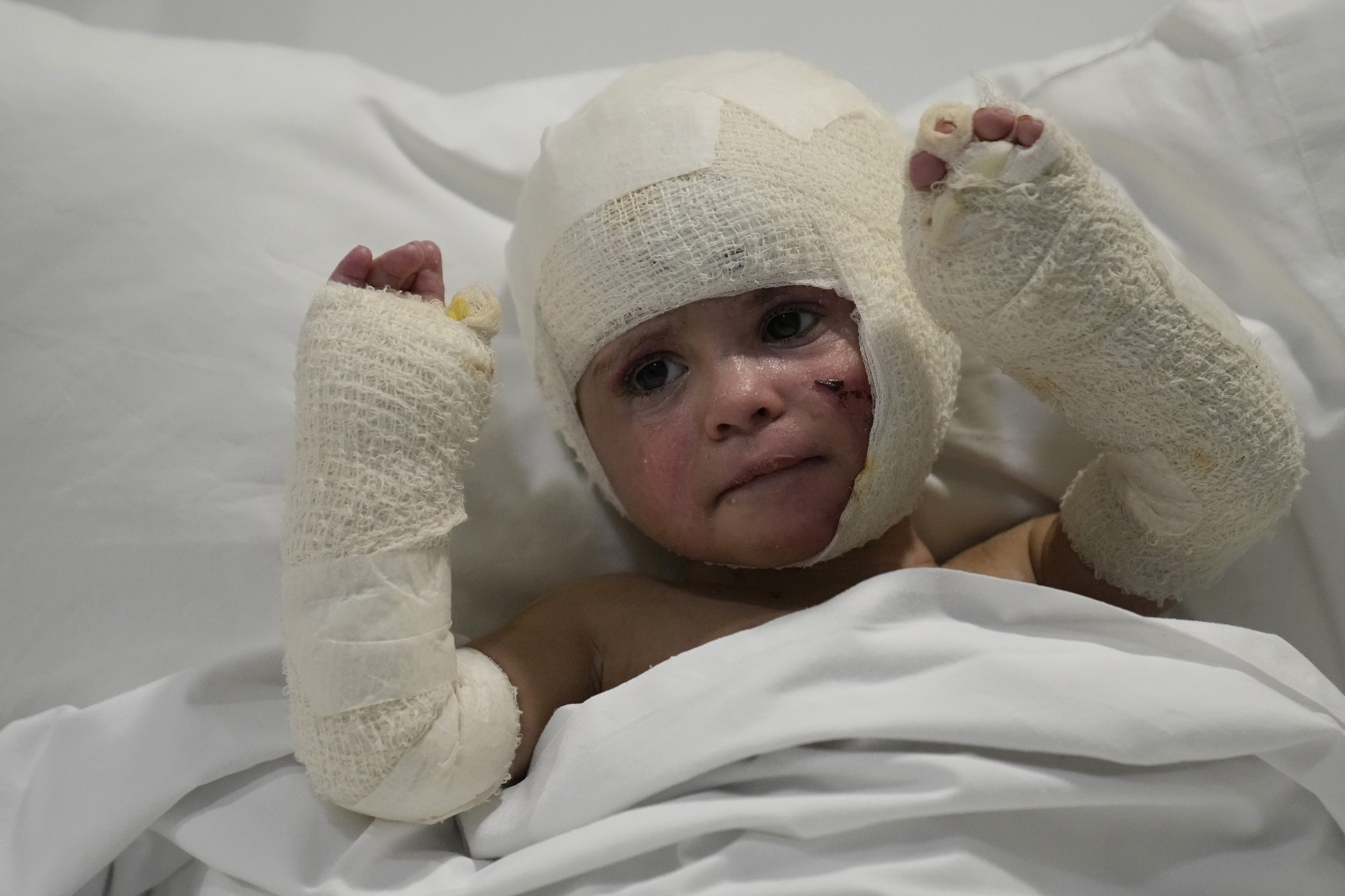 Ivana Skakye, 2, a Lebanese child who is suffering from third-degree burns over 40 percent of her body following an Israeli airstrike last September near their home in Deir Qanoun al Nahr,