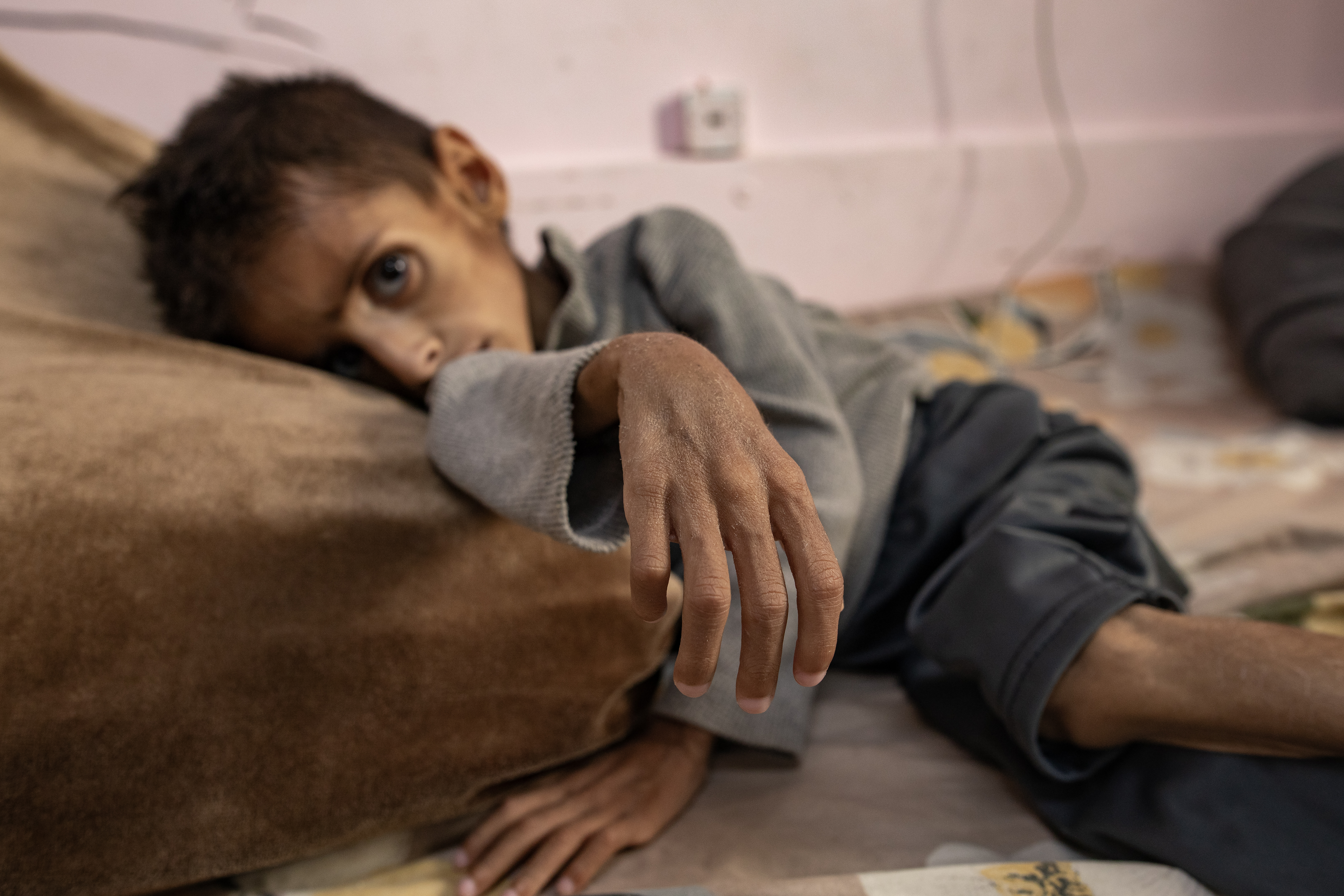 epa12137108 Five-year-old Palestinian child Osama al-Raqab, who is suffering from severe malnutrition receives treatment at Nasser Hospital in Khan Yunis, southern Gaza Strip, 26 May 2025. The Government Media Office in Gaza reported on 24 May that at least 58 people died due to malnutrition, and 242 others due to a lack of food and medicine since 02 March 2025, when Israel closed border crossings, preventing the entry of essential supplies. EPA-EFE/HAITHAM IMAD