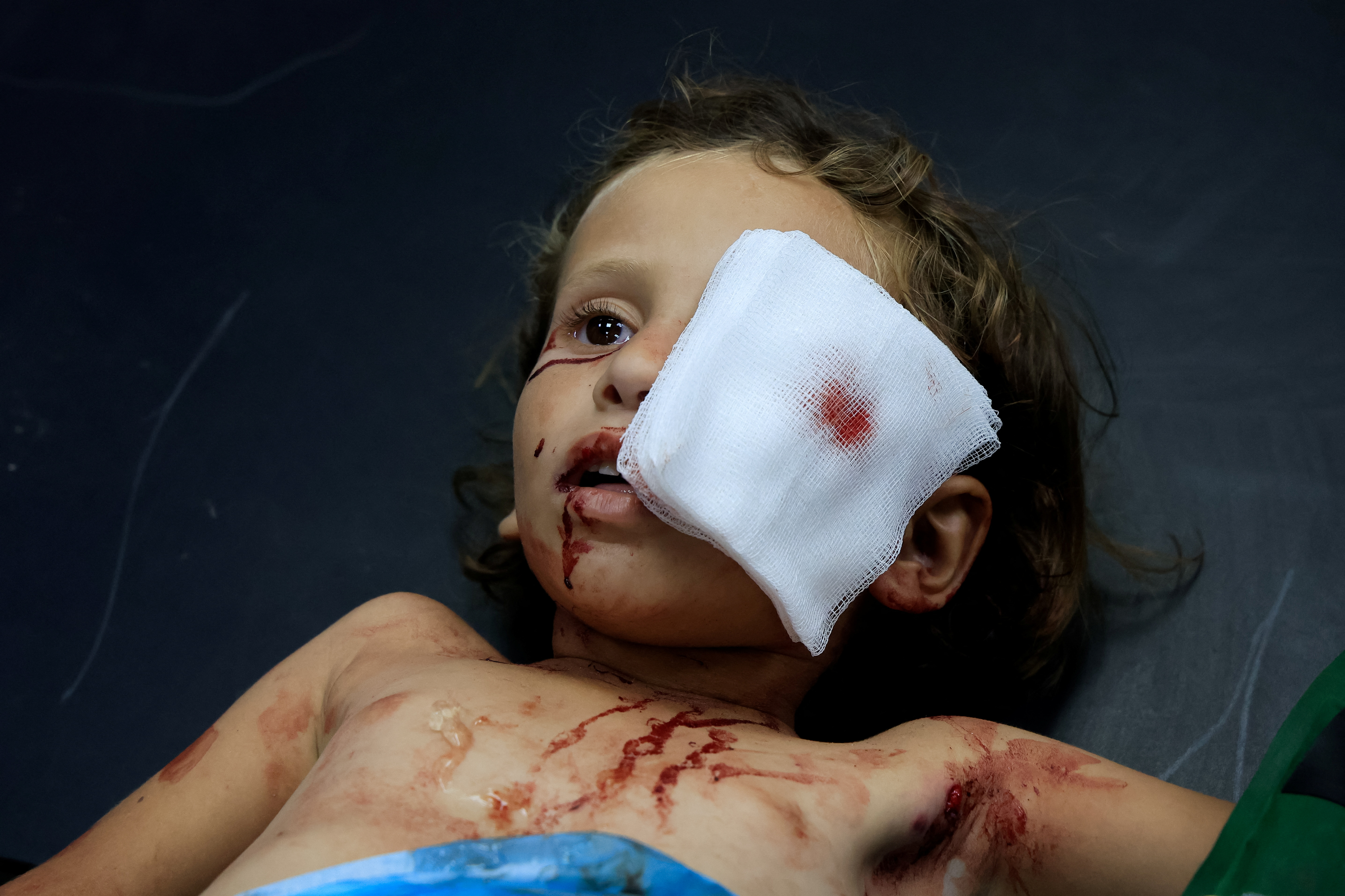 A wounded Palestinian girl receives treatment at Nasser Hospital after being wounded in an Israeli strike in Khan Younis, southern Gaza, July 17, 2025. [Hatem Khaled/Reuters]