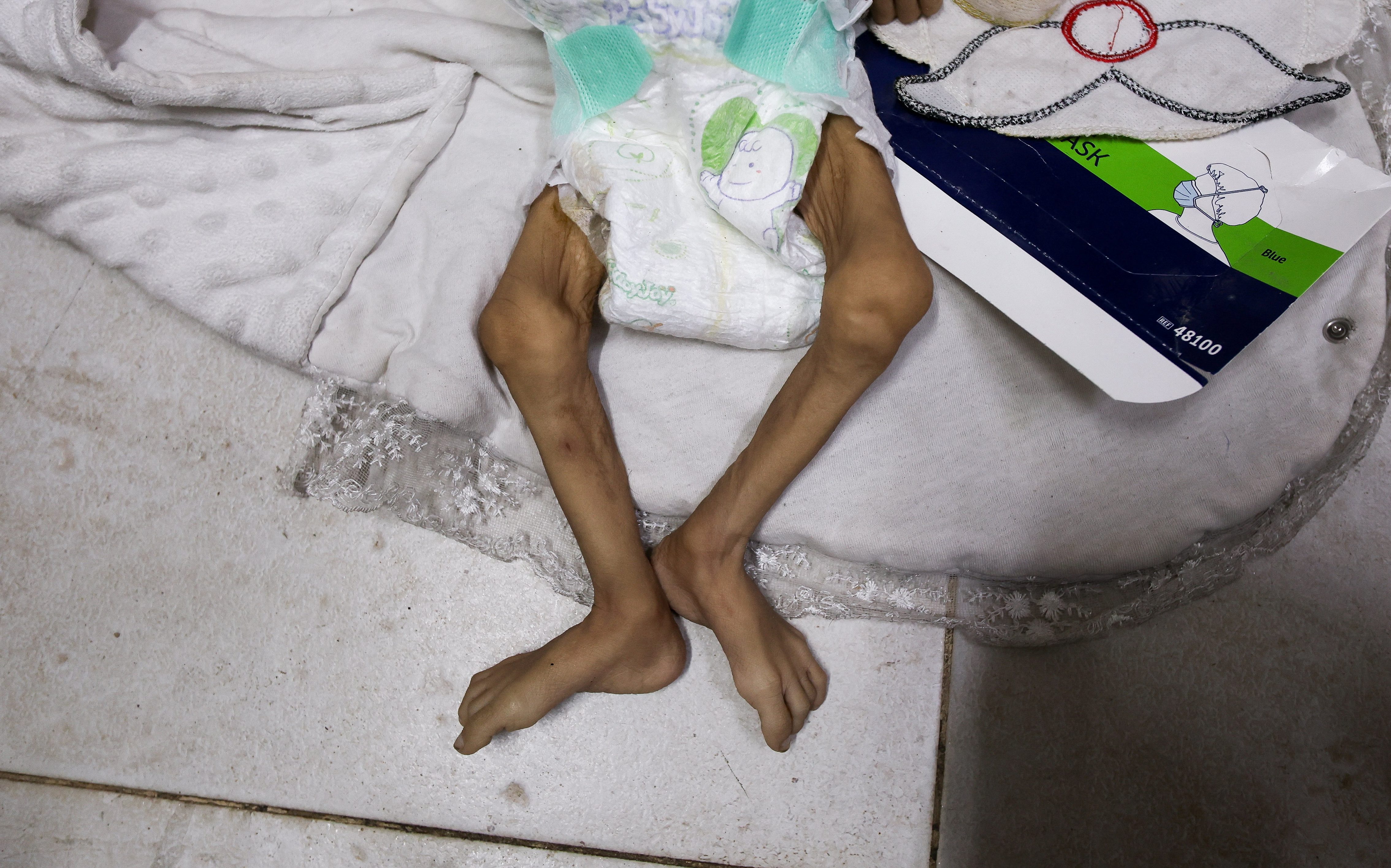 Photos of Gaza's worsening starvation