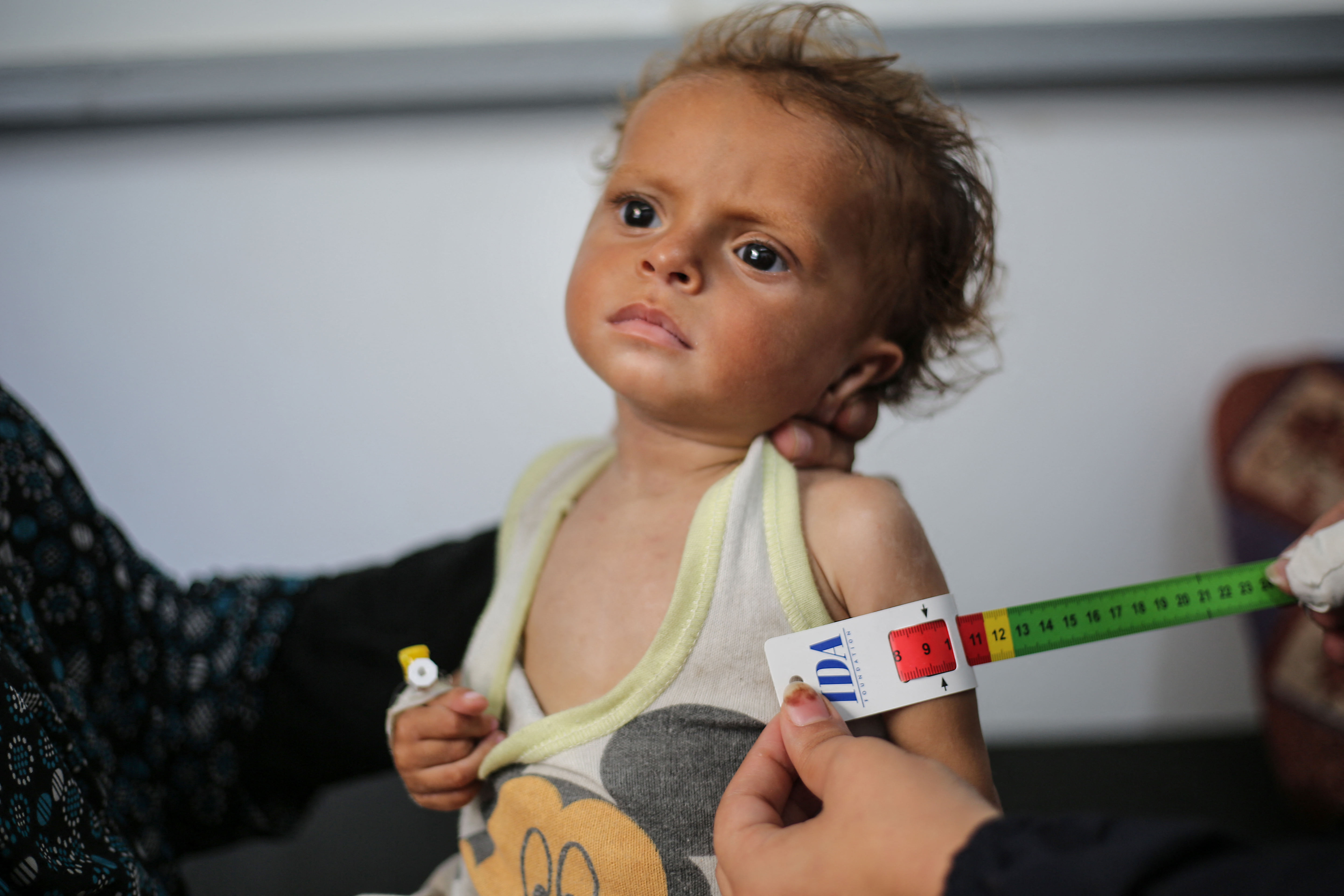 A malnourished Palestinian child is examined at Al-Awda hospital