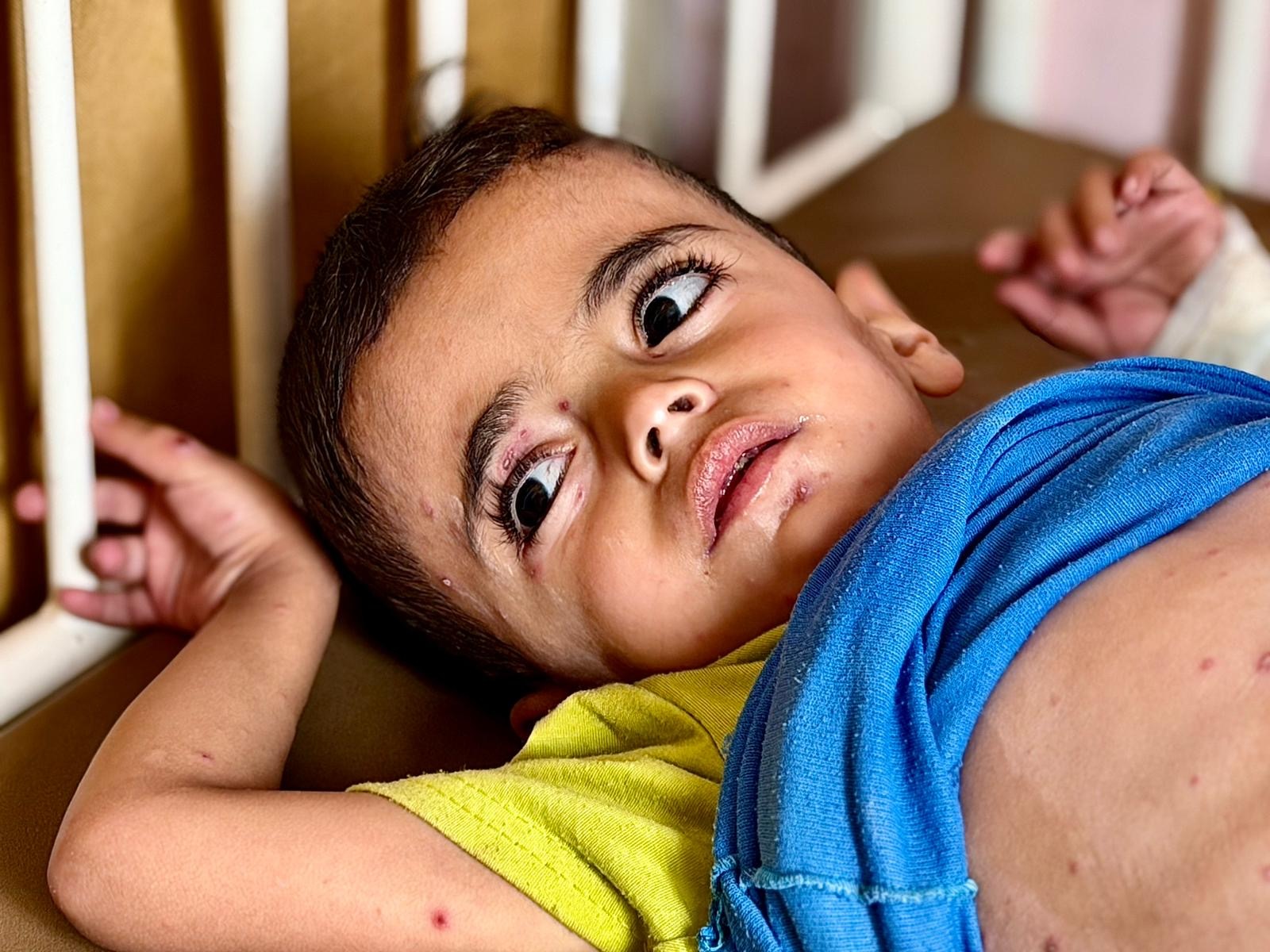 Six-year-old Yasser Arafat in a hospital bed in Nasser Hospital, Khan Younis